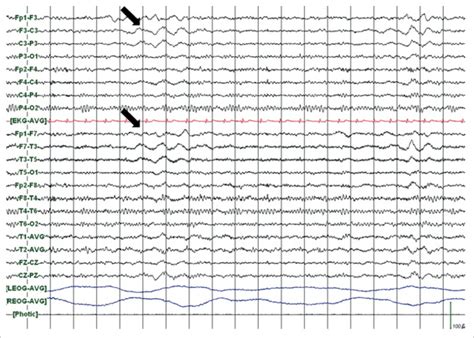 Eeg Shows Persistent Arrhythmic Delta Activity Over The Left