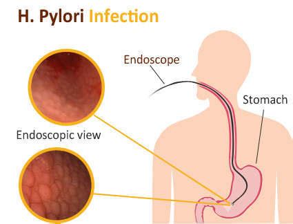 H Pylori Bacteria Infection Symptoms Diagnosis Treatment Prevention