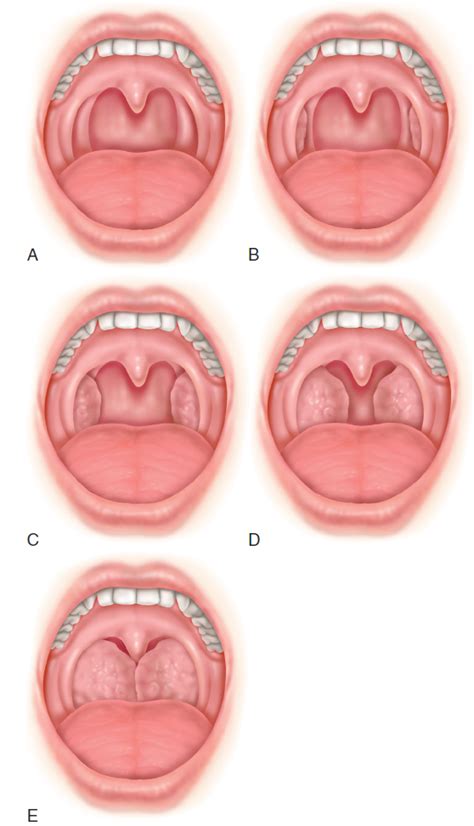 Tonsil Diagram Anatomy