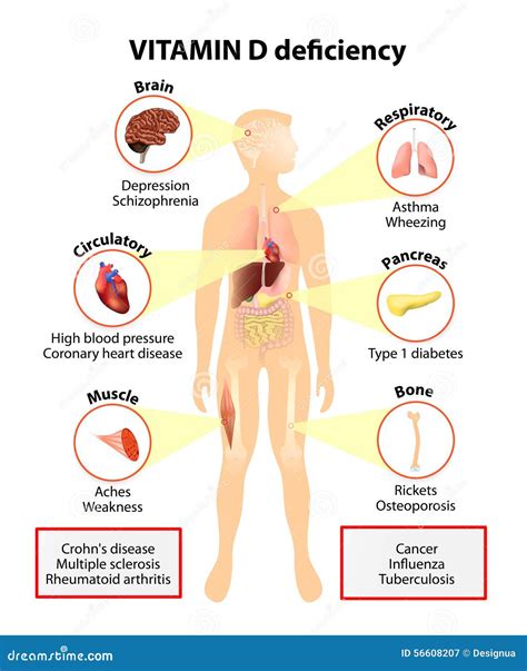 Vitamin D Deficiency Symptoms And Diseases Stock Vector Image 49227