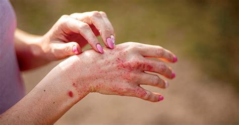 Atopic Dermatitis Eczema Types Symptoms And Causes