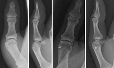 Figure From Avulsion Fracture And Complete Rupture Of The Thumb Radial Collateral Ligament