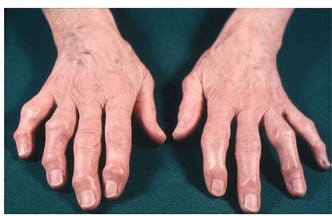 Osteoarthritis Disorders Of The Joints And Adjacent Tissues