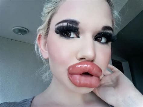 Cette femme qui rêve davoir les plus grosses lèvres du monde a subi une e injection