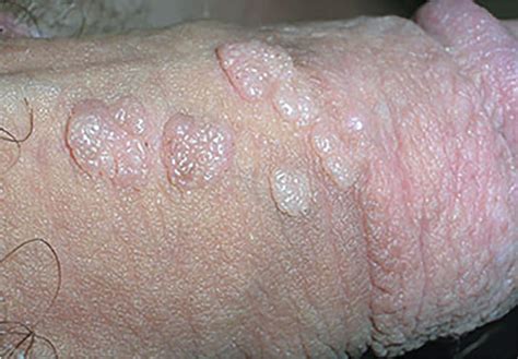 Virusul Hpv Asimptomatic Hpv Genital Warts Male Treatment My Xxx Hot Girl
