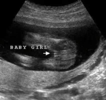 Anyone Had Wrong Gender On Ultrasound Babycenter