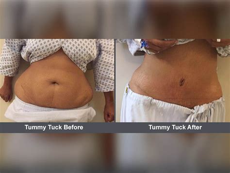 Tummy Tuck Before And After Results Cosmetic Surgeon