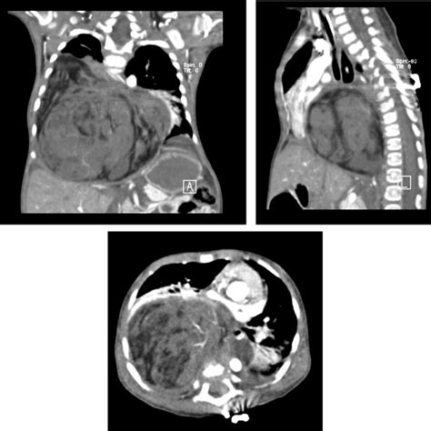 Coronal A Sagittal B And Axial C Ct Scans Demonstrating