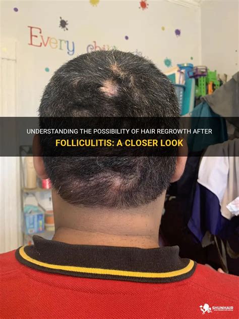 Understanding The Possibility Of Hair Regrowth After Folliculitis A