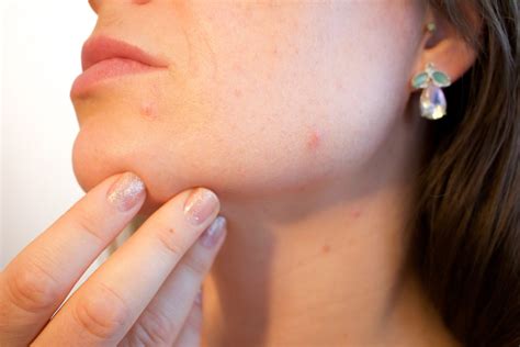 4 Prescription Acne Medication Alternatives And Theyre All Different