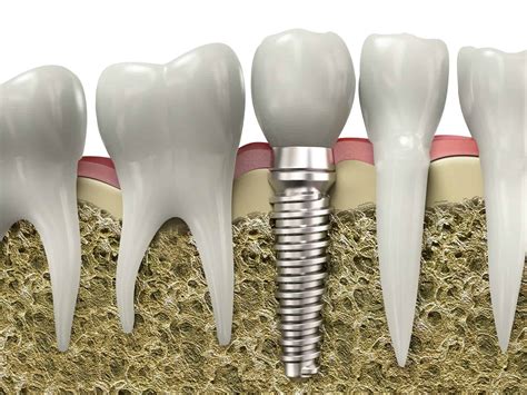 Dental Implants In Davie FL Dental Implants Near You
