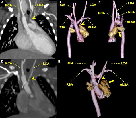 Anomalous Origin Of Left Common Carotid Artery From Left Pulmonary