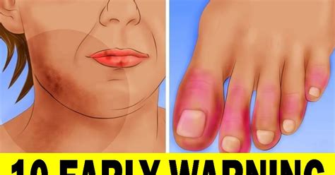 Here Are Early Warning Signs Of Lupus You Need To Know