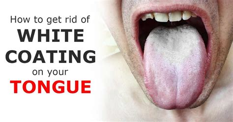 How To Remove White Patches On Your Tongue With 1 Ingredient White