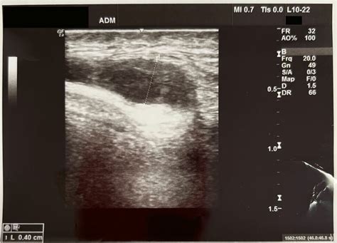 Superficial Temporal Artery Aneurysm In Ultrasound Doppler Exam
