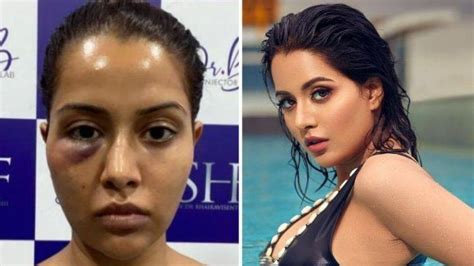 Tamil Actress Tamil Actress Raiza Wilson Forced To Undergo Dermatological Treatment Shares