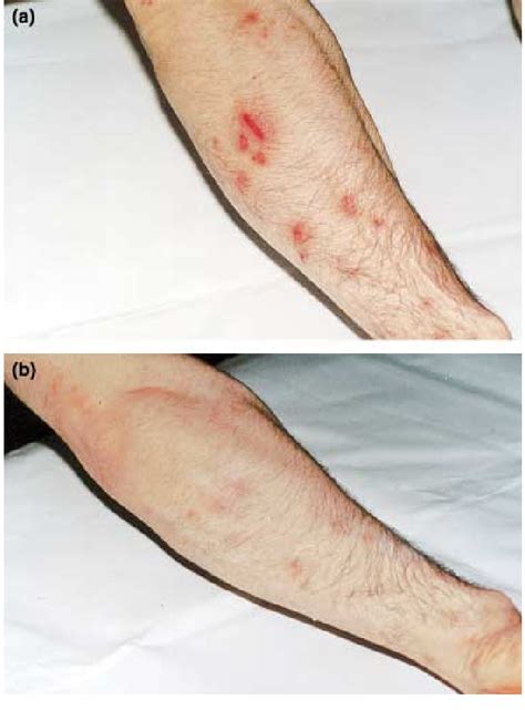 Treatment Of Contact Dermatitis With Nadh Ointment In A 40 Year Old
