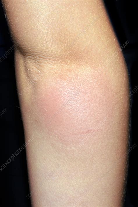 Allergic Reaction To Mosquito Bite Stock Image C0263300 Science