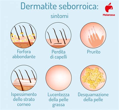 Dermatite Seborroica Cause Sintomi Trattamenti E Rimedi Naturali The