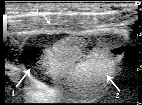 Transverse Sonogram Of The Floor Of The Mouth With A Dermoid Cyst 1