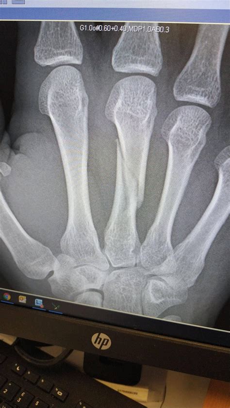 3rd Metacarpal Fracture Slipped Down Stairs Scrolller