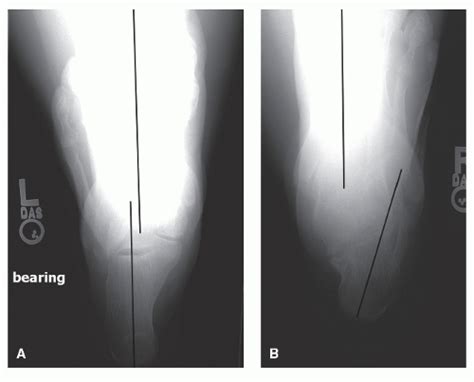 Neglected Calcaneal Fractures Musculoskeletal Key