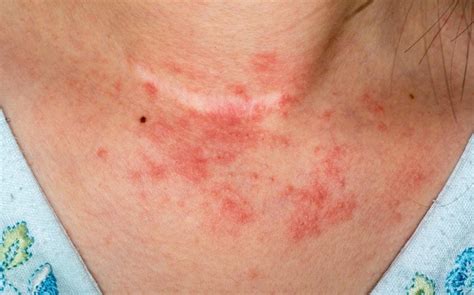 Apa Itu Dermatitis Seboroik Tips Dan Fakta Unik Menarik