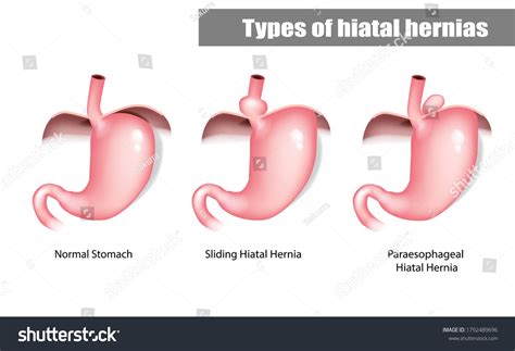 Types Hiatal Hernias Sliding Paraesophageal Abdominal Vetor Stock Livre De Direitos