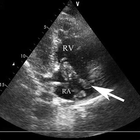 Echocardiogram Right Ventricular Inflow View Showing Right Atrial