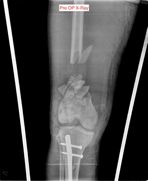 Hoffa fragment = coronal (frontal) plane fragment associated with comminution in the intercondylar notch. Distal Femur Fractures - Trauma - Orthobullets