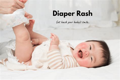 How To Treat Diaper Rash With Naturopathic Remedies Howtocure