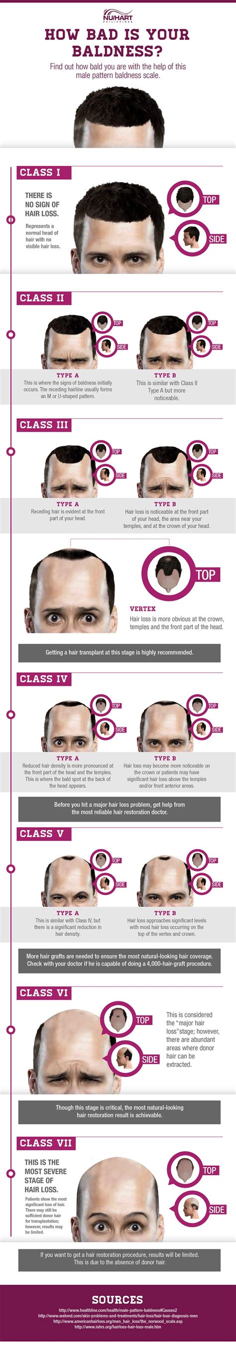The best selection of royalty free hair loss stages vector art, graphics and stock illustrations. 83 best images about Hair Loss & Restoration on Pinterest ...