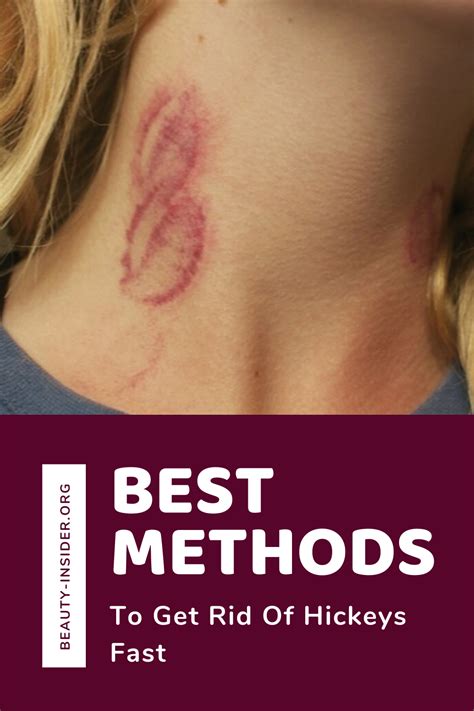 best methods to get rid of hickeys fast in 2020 hickeys how to get rid get rid of hickies