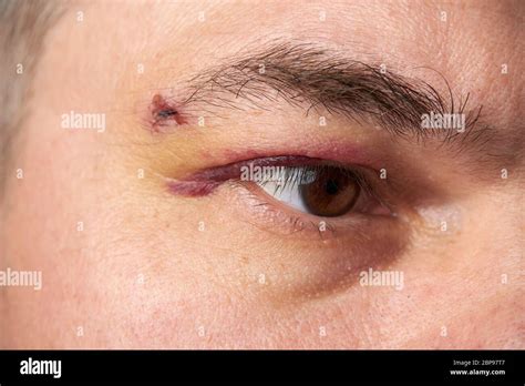 Close View Of A Bruise Near The Eye The Face Of A Man With A Hematoma