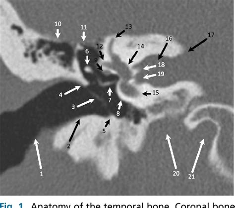 Fig 1 Anatomy Of The Temporal Bone Coronal Bone Algorithm Computed