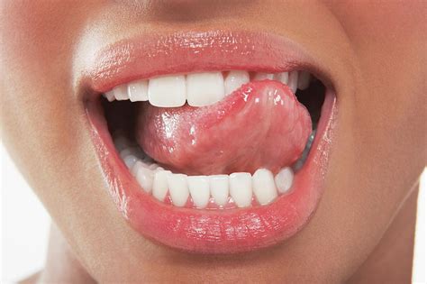 Почему печет во рту и на языке Синдром жжения языка и рта причины и лечение — Торговый Дом