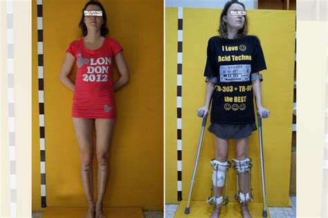 Aspiring Model Spends Thousands On Surgery To Make Legs Longer After