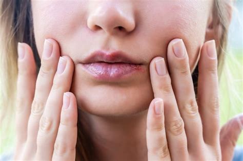 Cold Sore Or Pimple On The Lip How To Tell The Difference Livestrong