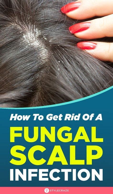 How To Get Rid Of Fungal Scalp Infection Causes Symptoms And Natural