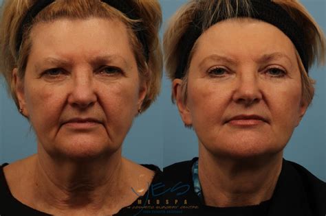 Brow Lift Before And After Photos Patient 168 Vancouver Bc Yes