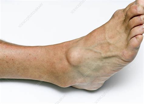 Ganglion Cyst On Ankle Stock Image C Science Photo Library