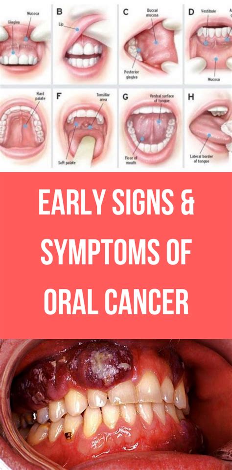 Early Signs And Symptoms Of Oral Cancer Wellness Tab