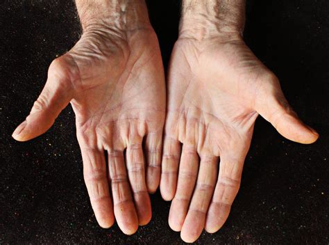 Causes Of Sweating Hands Wapvigo