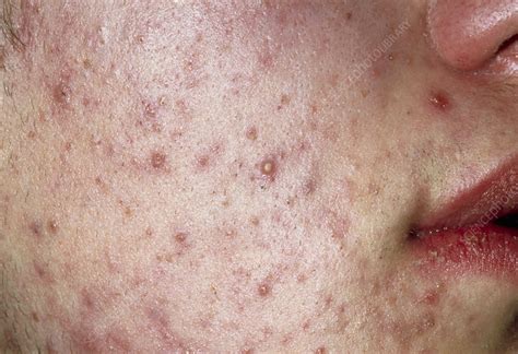 Acne Vulgaris On The Face Of A Young Man Stock Image M1080433