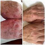 Age Spot Removal Hands Photos