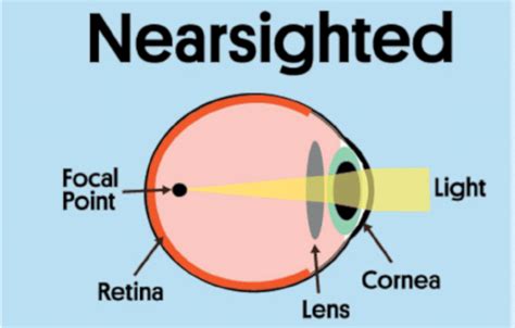 Nearsightedness Causes What To Know In 2024 International Clinics