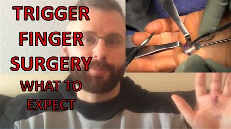 Trigger Finger Surgery What To Expect Youtube