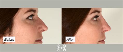 Non Surgical Nose Job Charleston Nose Reshaping Without