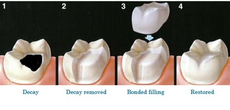 Failure to do so not only endangers your tooth but your overall health. New Cavities & Old Fillings - Dr. WM. Blaine Rudisill