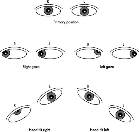 Examine Eye Movements Practical Neurology
